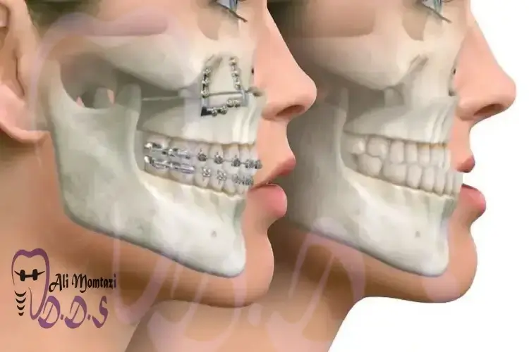اصلاح ارتفاع دندان و رابطه فکی