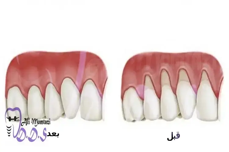 درمان پس رفت لثه در دندانپزشکی دکتر علی ممتازی