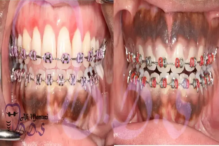 درمان تیرگی لثه در دندانپزشکی دکتر علی ممتازی
