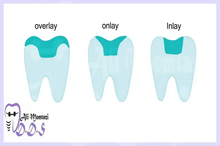 مراحل ترمیم دندان با آورله: از شروع تا پایان در دندانپزشکی دکتر علی ممتازی