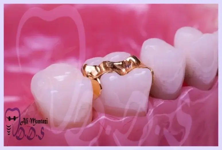 ترمیم دندان طلا دردندانپزشکی دکتر علی ممتازی