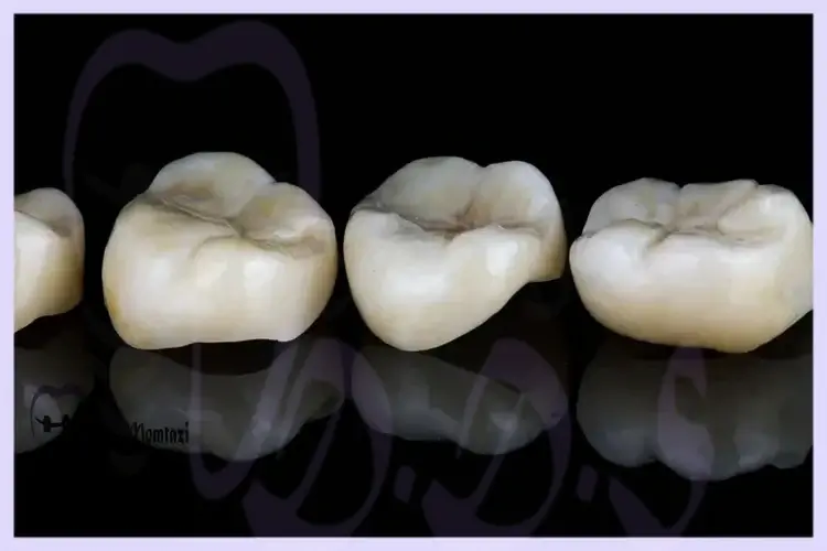 5. مناسبترین حالات برای ترمیم دندان با اینله