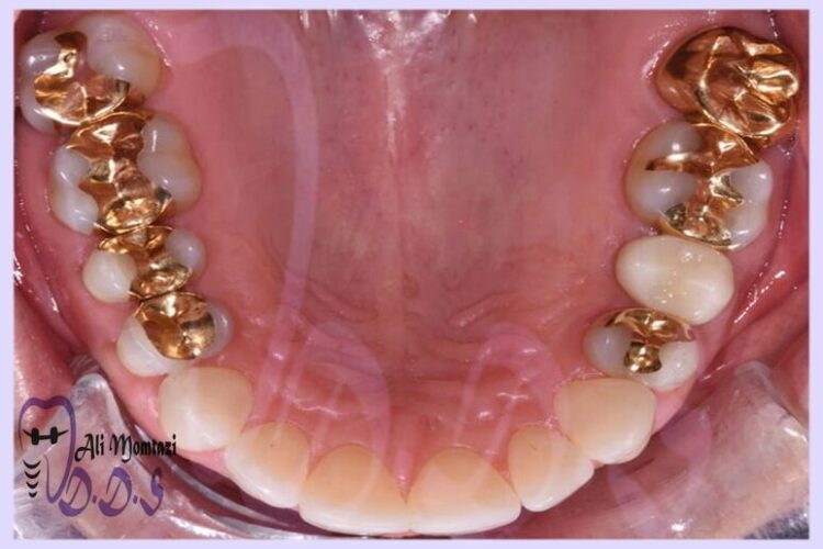 آیا ترمیم دندان طلا مناسب من است؟
دندانپزشکی دکتر علی ممتازی