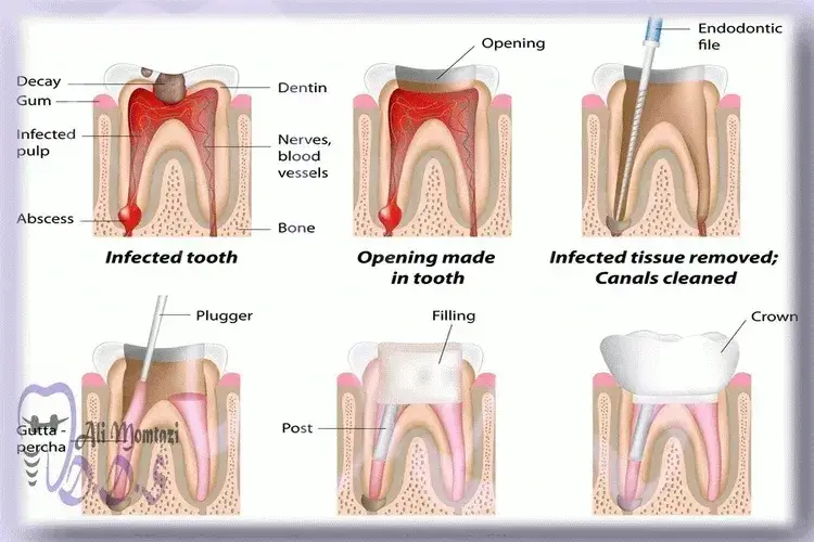 فرآیند درمان ریشه مجدد دندان دردندانپزشکی دکترعلی ممتازی