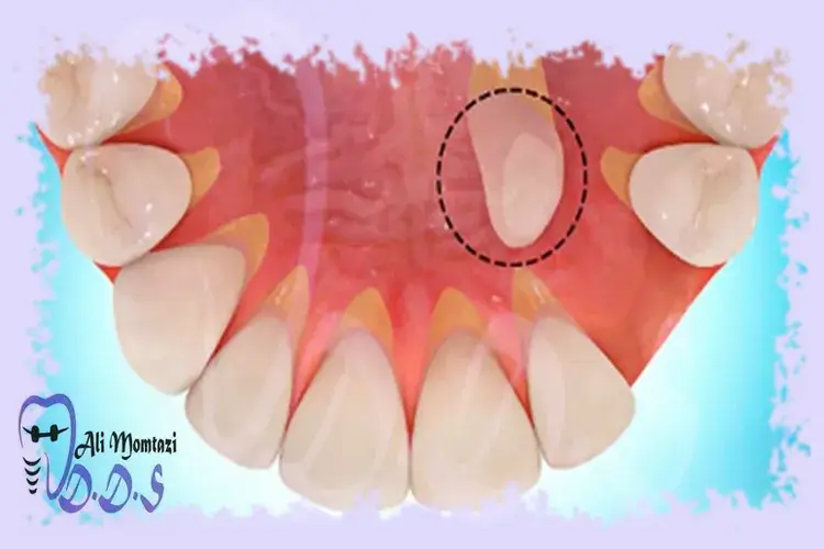 چرا جراحی دندان نهفته ضروری است؟