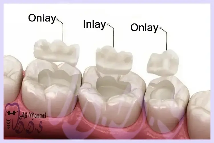 ترمیم دندان با آورله فرق اینه آنله