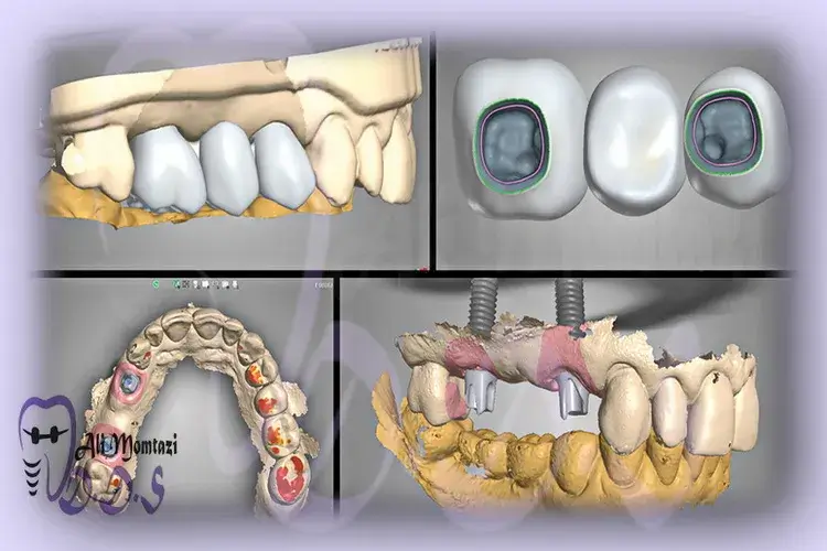 کاربردهای بالینی و پزشکی روکش‌های دیجیتال ایمپلنت در دندانپزشکی دکتر علی ممتازی