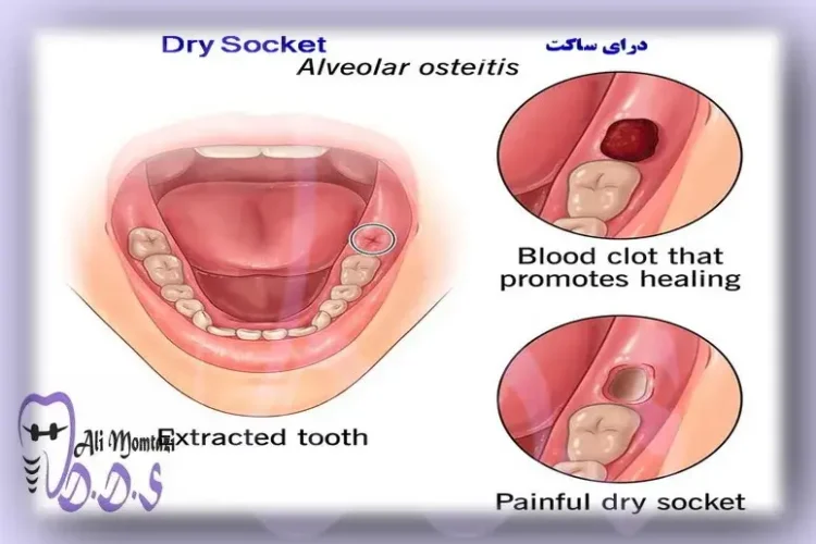 علت‌های درای ساکت در دندانپزشکی دکتر علی ممتازی