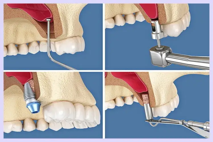 چرا به جراحی لیفت سینوس نیاز داریم؟