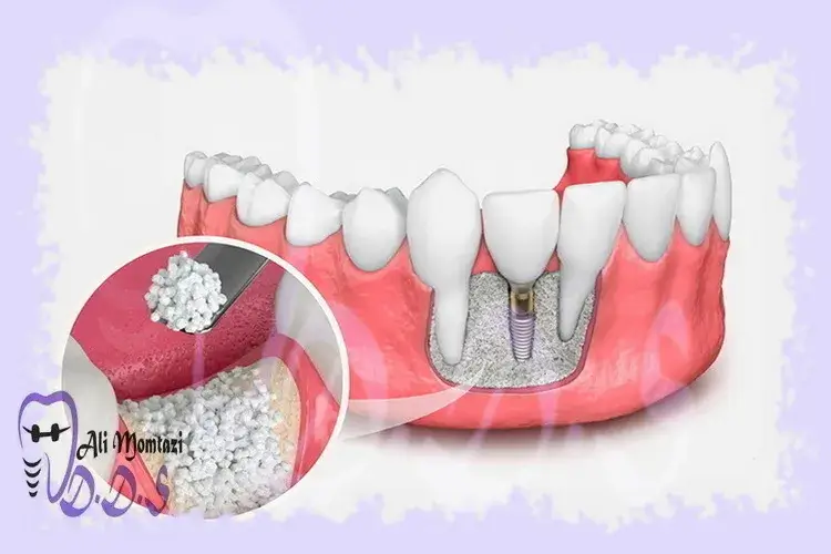جراحی پیوند استخوان: نتایج شگفت‌انگیز و باور نکردنی! در دندانپزشکی دکتر علی ممتازی