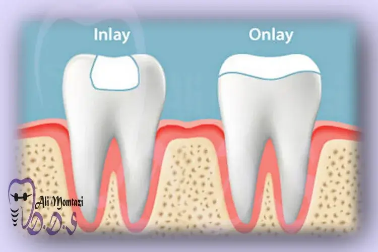 هزینه دندان اینله و دندان آنله در دندانپزشکی دکتر علی ممتازی