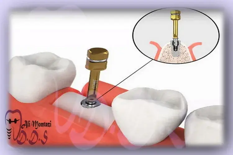 همه چیز درباره خارج کردن پیچ شکسته ایمپلنت در دندانپزشکی دکتر علی ممتازی