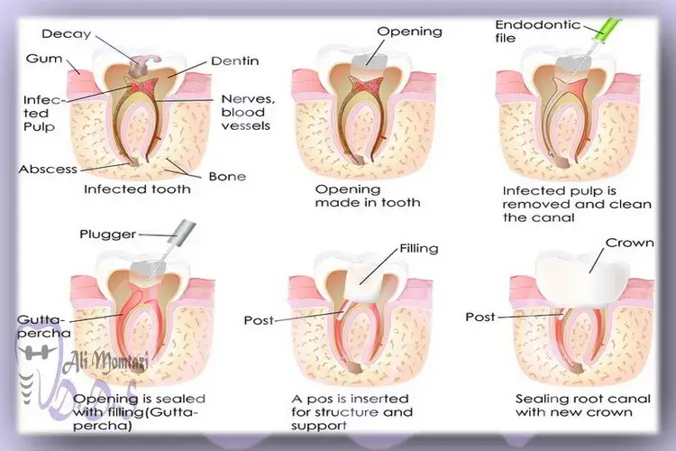درمان ریشه دندان در جدول در دندانپزشکی فول دیجیتال دکتر علی ممتازی