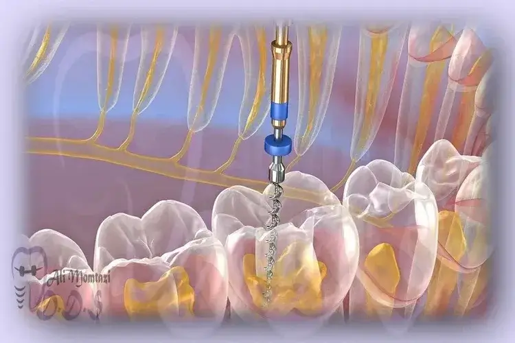 درمان ریشه دندان راهنمای کامل و آسان