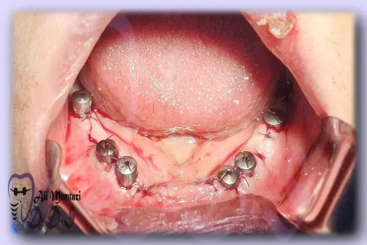 مراحل جراحی ایمپلنت فول موت دندانپزشکی دکتر علی ممتازی