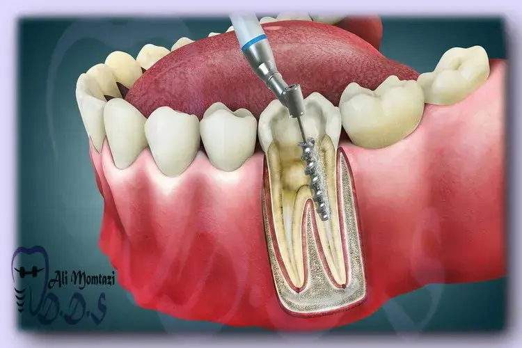 درمان ریشه دندان | دندانپزشکی دکتر علی ممتازی