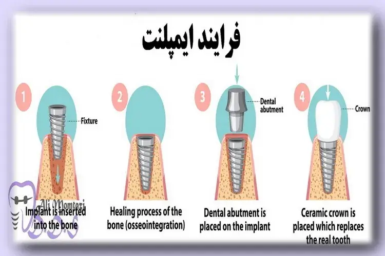 فرایند ایمپلنت
در دندانپزشکی دکتر علی ممتازی