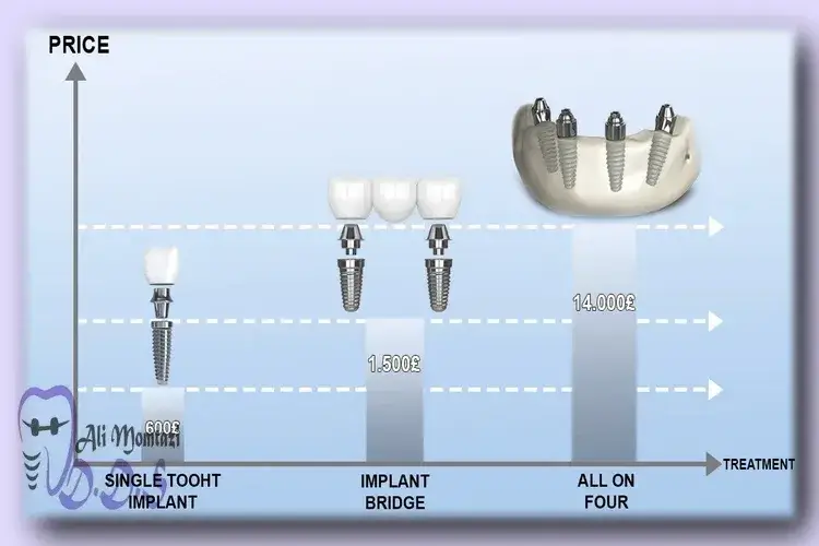 قیمت ایمپلنت فوری در دندانپزشکی دکتر علی ممتازی