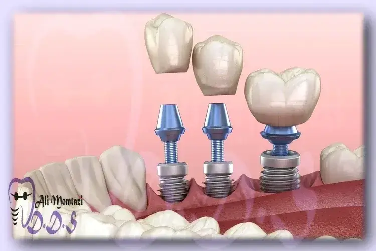 مزایای ایمپلنت فوری در دندانپزشکی دکتر علی ممتازی