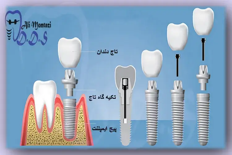 ایمپلنت دندانهای زیبایی انواع ایمپلنت دندان در دندانپزشکی دکتر علی ممتازی