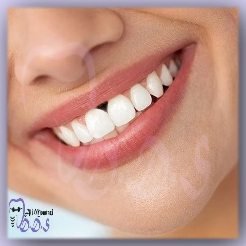درمانهای پزشکی برای رفع تیرگی لثه | دکتر علی ممتازی
