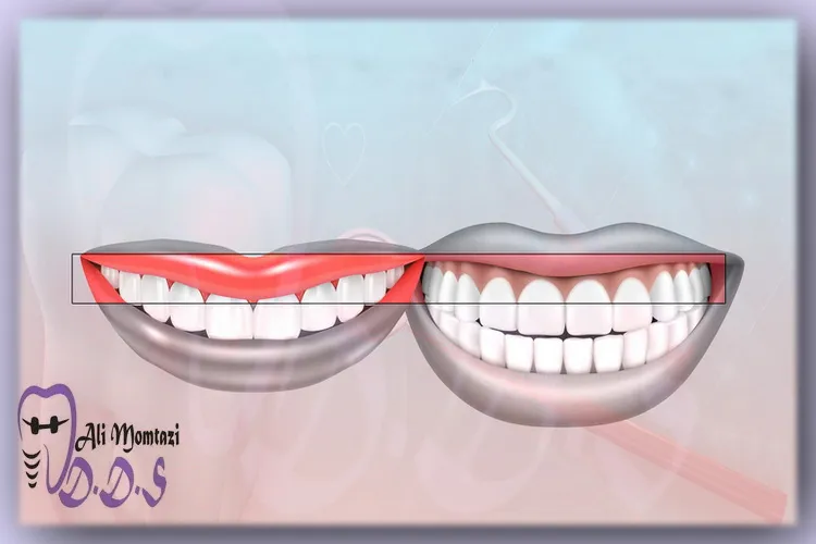 راههای درمان تیرگی و پس رفت لثه برای افزایش ارتفاع و زیبایی لثه | دکتر علی ممتازی