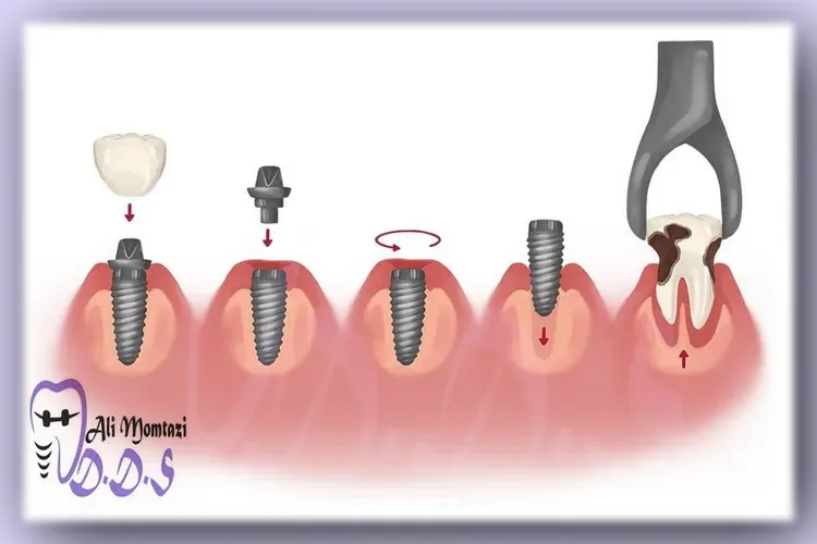 فرآیند نصب ایمپلنت دندان
 با متخصص دکتر علی ممتازی