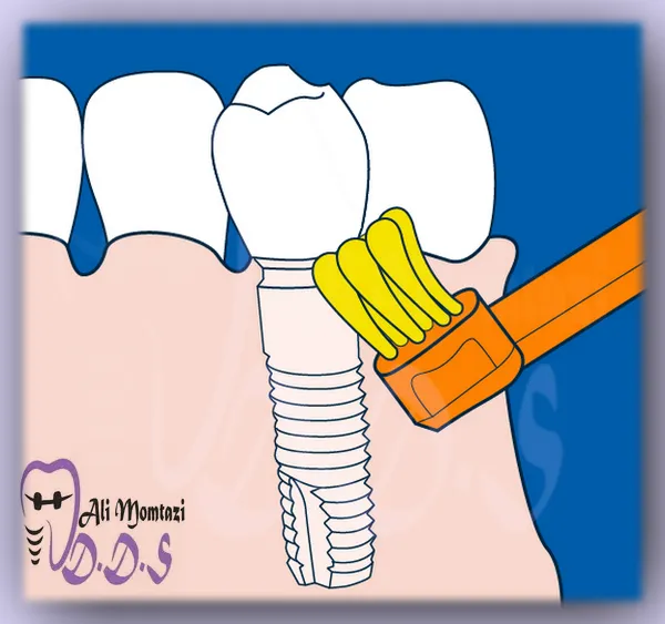 مراقبت‌های پس از ایمپلنت دندان
و راهنمایی بیشتر توسط دکتر علی ممتازی