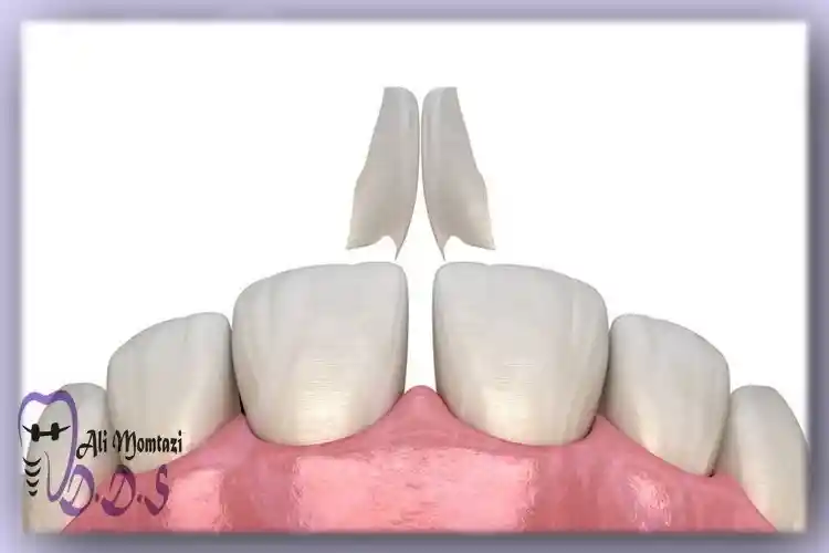 باندینگ دندان | دکتر علی ممتازی