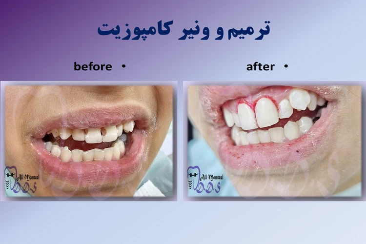 تفاوت ترمیم کامپوزیت و لمینیت