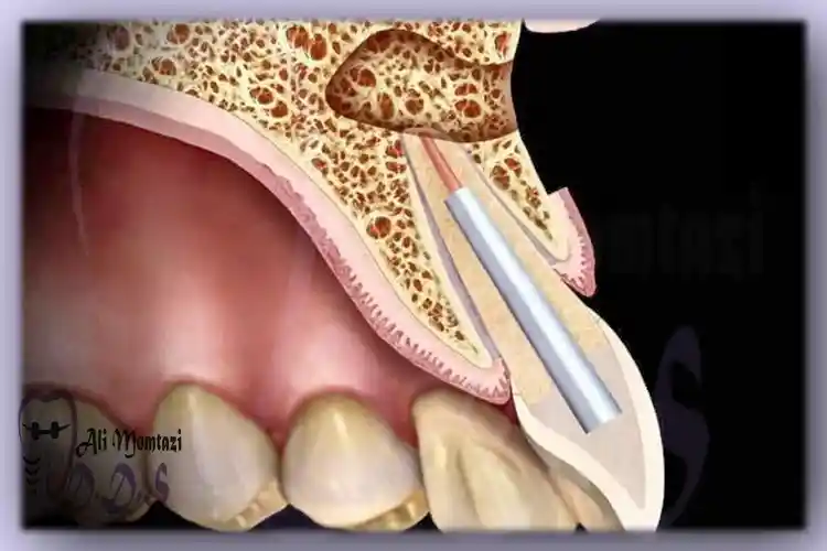 اپیکوسرجری و درمان ریشه دکتر علی ممتازی