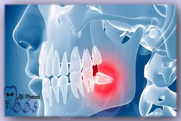 جراحی دندان عقل نهفته | توسط دکتر علی ممتازی