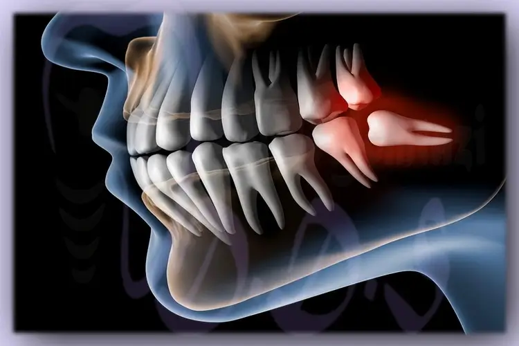 نشانه‌های دندان عقل نهفته | توسط دکتر علی ممتازی