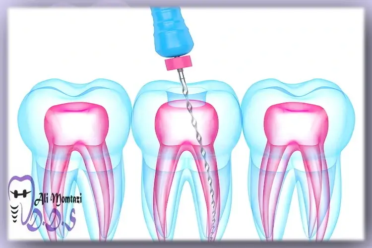 عصب کشی دندان چیست