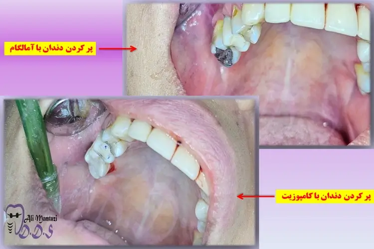 مقایسه پر کردن با آمالگام و کامپوزیت | توسط دکتر علی ممتازی