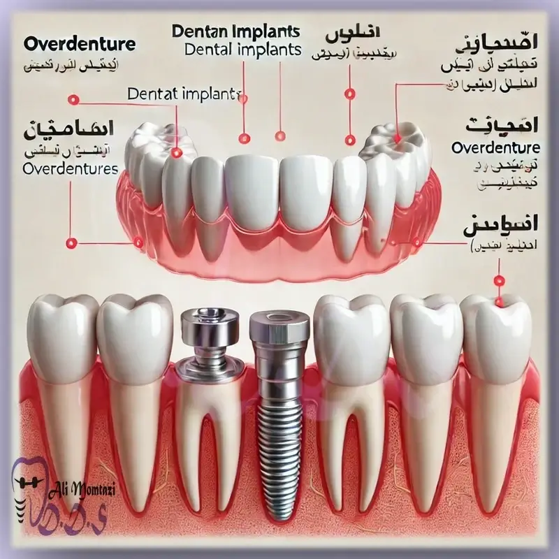 اجزای اور دنچر | برسی دکتر علی ممتازی